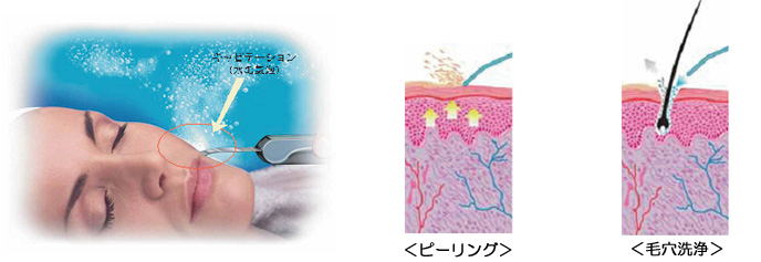 Bio Skin キャビテーション(超音波+水による毛穴洗浄) アクアピーリング Bio Skin キャビテーション(超音波+水による毛穴洗浄) アクアピーリング